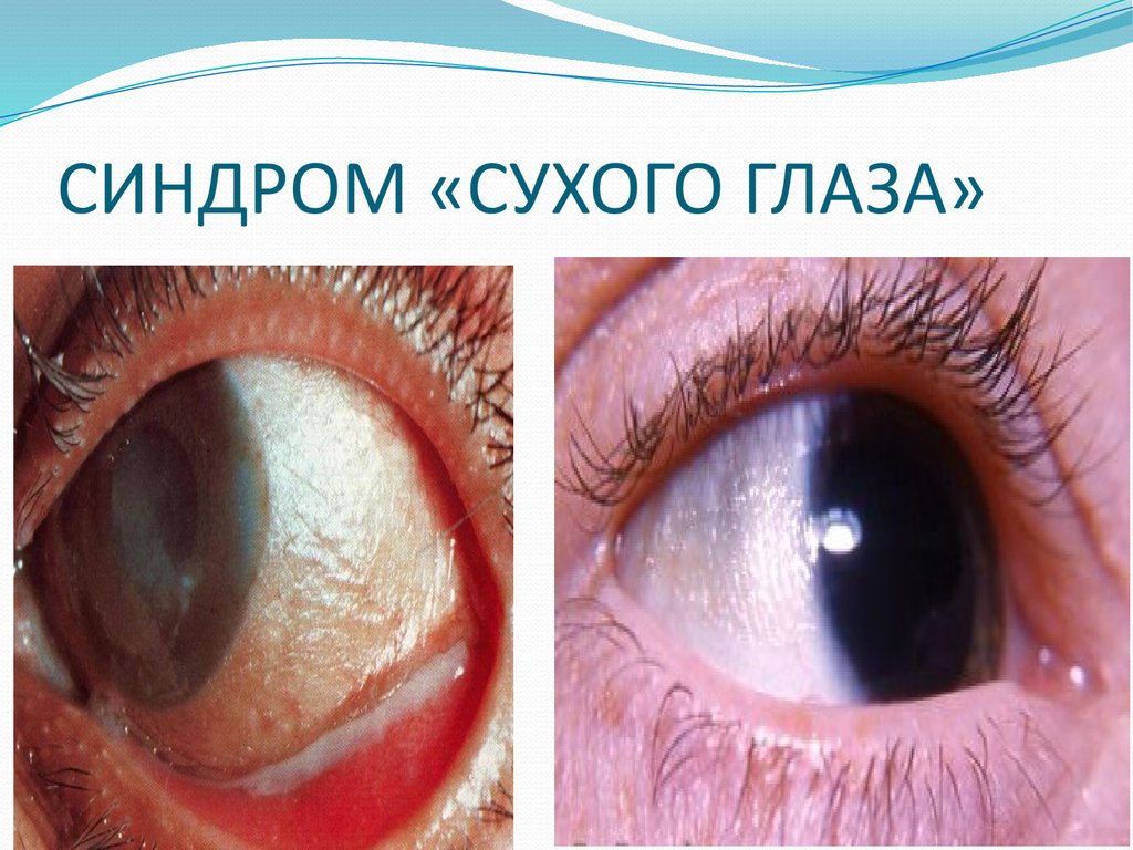 синдром сухого глаза