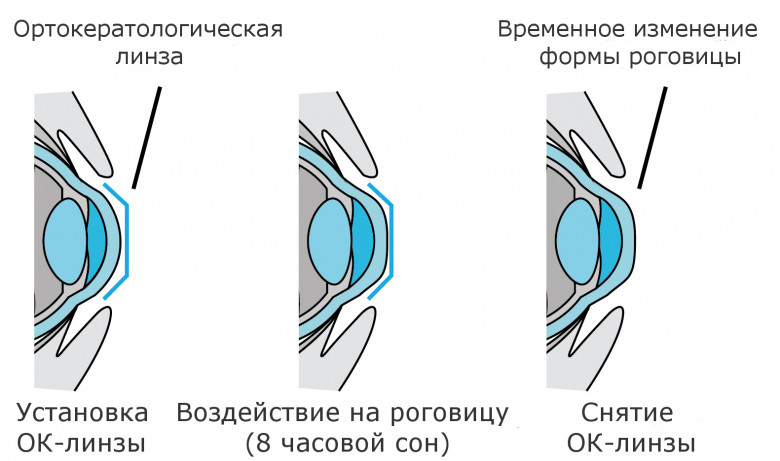 Как действуют ночные линзы